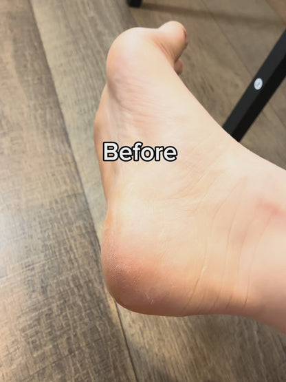 Solé Electric Callus Remover